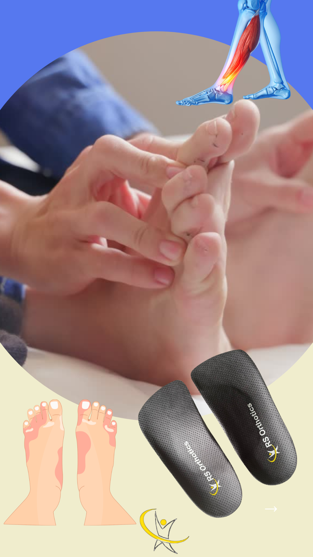 How Orthotic Insoles Stop Overpronation - Approved NHS Solutions